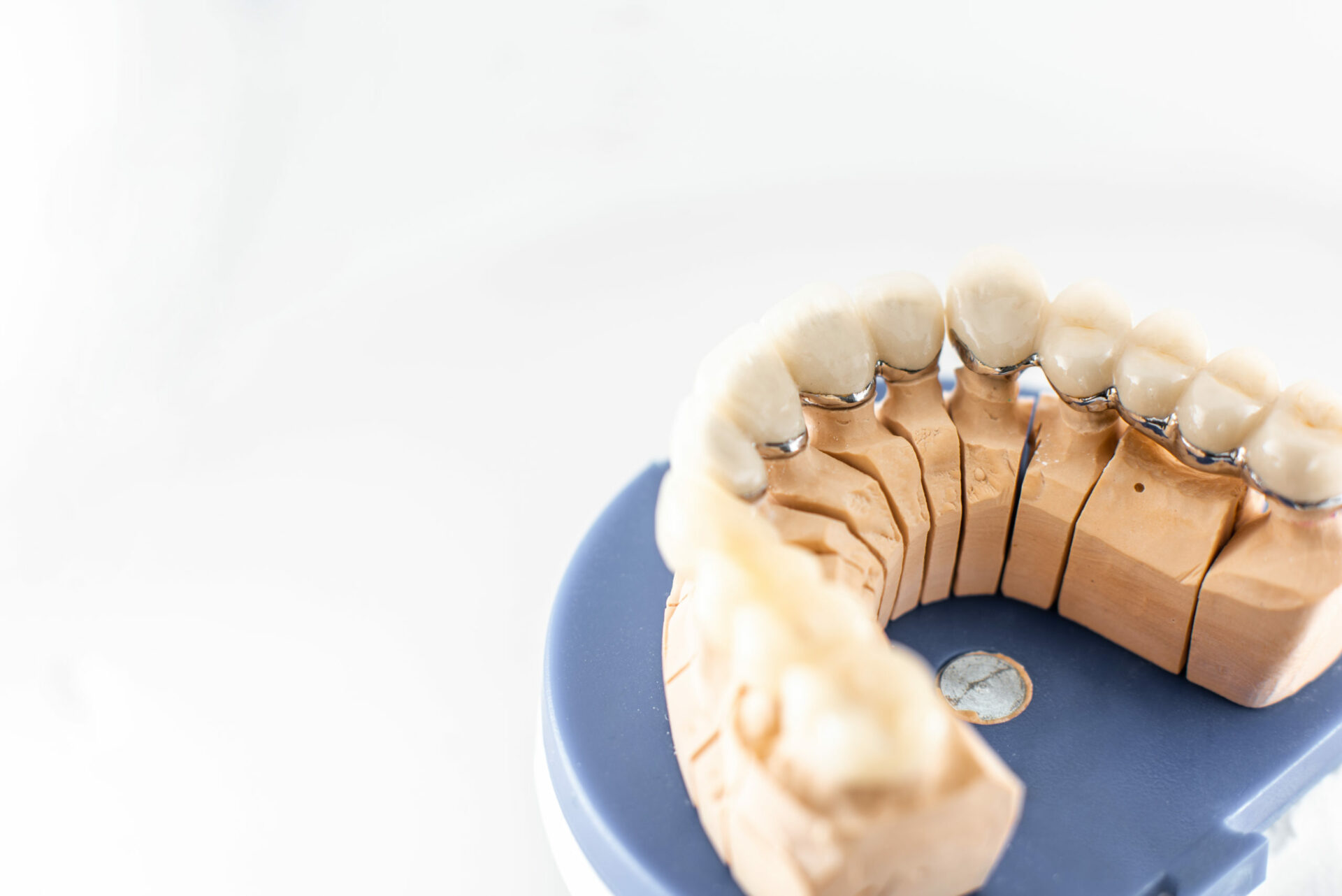 Dental crowns for your teeth in the City of London