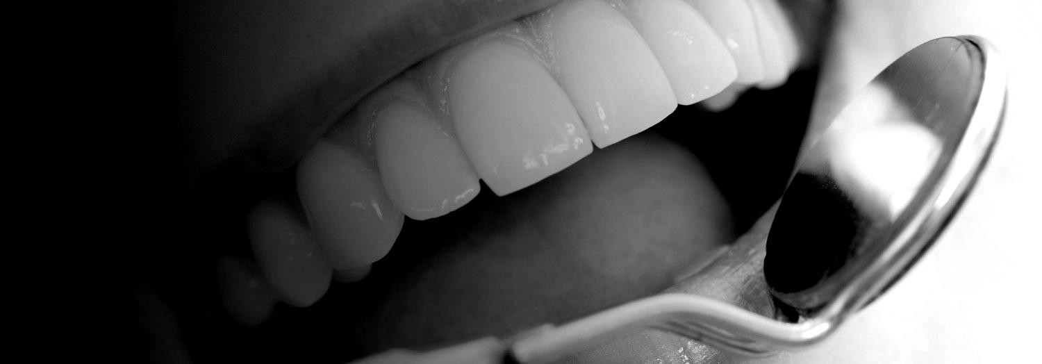 Benefits of Composite Bonding or White Filling - London Specialist Dentists